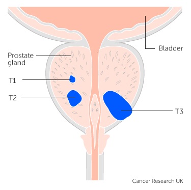 T Staging types 1,2, and 3