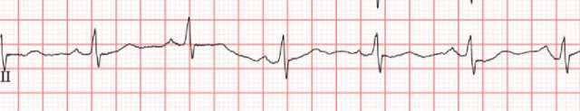 Gene's ECG that pointed to an MI: Myocardial Ischemia