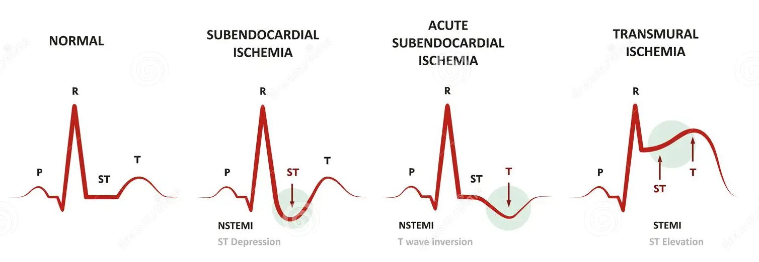 Myocardial Ischemia ECG examples with normal for reference.