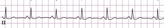 Normal ECG in Lead II