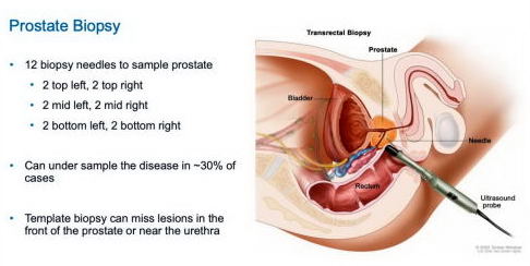 Prostate Biopsy - 12 target areas
